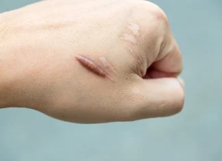 65 de citate cicatrice care te vor ajuta să depășești durerea și să mergi mai departe